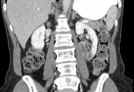 Image result for Renal Infarction