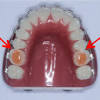 Most people find that they are more comfortable and can chew food more properly in 2 to 3 weeks after the braces go on. 1