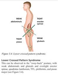 To allow relaxing of your abdominals, you`re require to tuck in your chin, and stand upright without hanging forward or slouching. Lower Crossed Pattern Syndrome Anterior Pelvic Tilt And Swayback Posture Increased Lordotic Curve Of The Lu Swayback Posture Quadratus Lumborum Bursitis Hip