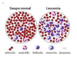 La leucemia è un termine con il quale si indica un insieme di malattie maligne, vari tipi di cancri o tumori caratterizzati dalla proliferazione neoplastica di una cellula staminale emopoietica e si traduce in un numero elevato di globuli bianchi anormali. Leucemia Que Es Sintomas Causas Prevencion Y Tratamiento Top Doctors