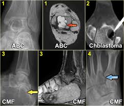 Morgan department of radiology & radiological science, the johns hopkins. The Radiology Assistant Differential Diagnosis Of Bone Tumors