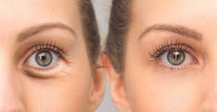 Restylane San Diego Ca La Jolla Restylane Under Eye Wrinkles Undereye Eye Wrinkle