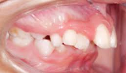 Maloclusion En Ninos Maxillaris