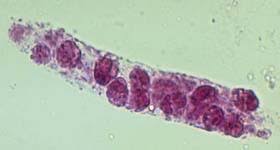 Image result for Urinary Cast