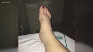 Image result for Snake Bite