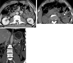 Colon cancer affects both men and women, and all unfortunately, at the onset, colon cancer has few, if any, symptoms. Appendicite Et Diverticulites Du Colon Les Formes Pieges Sciencedirect