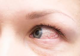 9 Causes Of Red Eyes