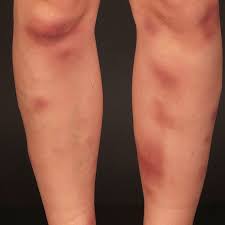 Image result for erythema nodosum