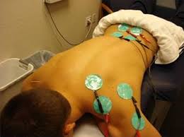 Image result for Electrical Stimulation Therapy