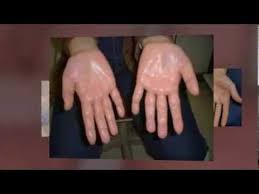 Visit Our Site Http Www No Ets Com For More Information On Hyperhidrosis Hyperhidrosis Causes The Hyperhidrosis Excessive Underarm Sweating Sweating Too Much
