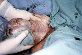 Image result for Breech Delivery