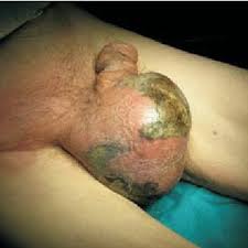 A prospective clinical study at a tertiary care center. Initial Presentation Of The Patient With Fournier S Gangrene Before Download Scientific Diagram