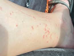 Image result for mite bites on humans