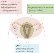 Endometriosis can be a challenging condition to manage. Endometriosis And Infertility Pathophysiology And Management The Lancet