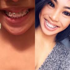 It's hard to say exactly how long it will take you to get pregnant. 1 Year And 7 Months Results I Get My Braces Off In A Few Months I Have Two Turbo Bites Behind My Two Front Teeth My Next Appointment Is Next Week