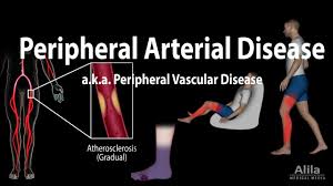 Peripheral Artery Disease Pathophysiology Causes Symptoms Diagnosis And Treatments Animation Youtube