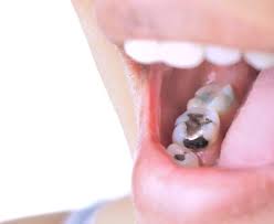 The price depends on the cleaning you need and whether you have a dental insurance plan. How Much Does Teeth Cleaning Cost In Canada North York Dental Clinic