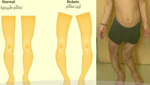 علاج لين العظام للاطفال والكبار بالاعشاب والمكملات الغذائية pants fashion pajama pants