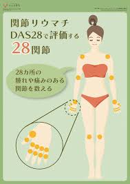 関節リウマチ das28で評価する28関節 関節リウマチ 関節 専門医