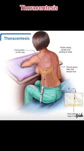 Image result for Thoracentesis