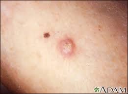 If you've received a diagnosis, here are some things you need to know about the condition. Squamous Cell Skin Cancer Information Mount Sinai New York