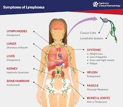 Blood tests, including those that measure organ function can be performed. Lymphoma Cfch Centre For Clinical Haematology