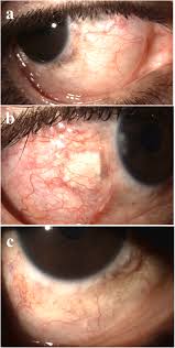 Image result for melanosis sclera