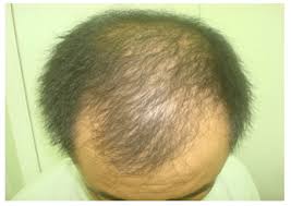 A measure called ferritin indicates the iron level in the body. A Scientific Hypothesis On The Role Of Nutritional Supplements For Effective Management Of Hair Loss And Promoting Hair Regrowth