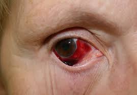 Den subtyp), die getrenntschreibung unterscheidet dieses virus von der gattung, die im englischen ebolavirus geschrieben wird. Hyposphagma Wikipedia