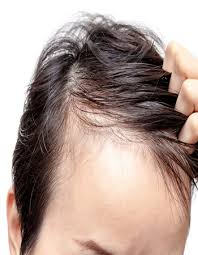 Stempiatura fisiologica a 20 anni. Stempiatura Uomo Quali Sono Le Cause E Rimedi Per Curarla