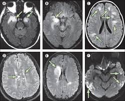 Chronic fatigue syndrom in community. A Clinical Approach To Diagnosis Of Autoimmune Encephalitis The Lancet Neurology