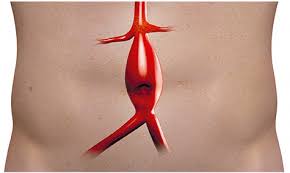 Por mais que um aneurisma de aorta abdominal possa ser fatal em caso de rompimento, a novidade é que o tratamento eficaz pode impedir que isso ocorra. Aneurisma De Aorta Abdominal El Avance De Las Tecnicas Endovasculares