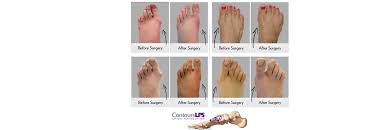 Plantar Plate Repair Surgery Symptoms Causes Of A Plantar Plate Injury Surgery Surgery Recovery Feet Care
