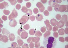 Medicina enfermedad infecciosa transmitida al hombre por la picadura de los mosquitos anofeles hembras que produce anemia y fiebre alta. Paludismo Malaria Enfermedades Tropicales Enfermedades Parasitarias Enfermedades Infecciosas Enfermedades Medicina Interna Basada En La Evidencia