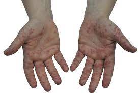 Hand Fuss Mund Krankheit Kinderkrankheiten Und Impfungen Medizinisches Baby Swissmom Ch
