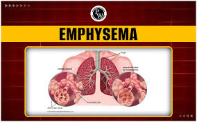 Image result for Emphysema