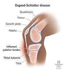 Image result for Knee Bulge Sign