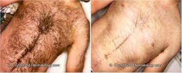 Laser hair removal gives you effective permanent hair reduction anywhere on your body including the face, legs, back, underarms or bikini area. Laser Hair Removal Crutchfield Dermatology Eagan Minnesota