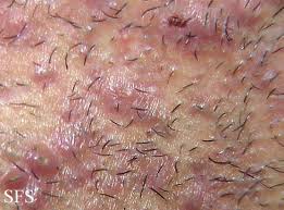 While ingrown hairs may look a lot like pimples, they're actually foreign body reactions that occur when something goes wonky in your hair follicle, explains dr. Ingrown Hair Prevention Infection Scars Pictures Cure Removal Ehealthstar