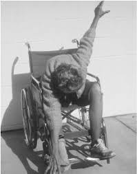 Symptoms Of Catatonia Stupor Posturing