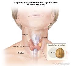 Females are more likely to get thyroid cancer than males. Thyroid Cancer Treatment Adult Pdq Patient Version National Cancer Institute