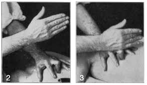 Typically, it is positive in cholecystitis, but negative in choledocholithiasis, pyelonephritis, and ascending cholangitis. Murphy S Sign Litfl Medical Eponym Library