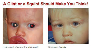 Cancer can also spread to the eye from other parts of the body. Signs And Symptoms Of Retinoblastoma We C Hope