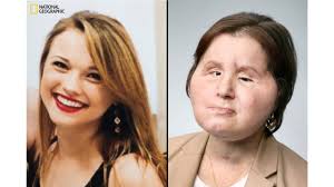 Suicide survivor gets historic face transplant