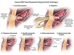 Incorrect Gastrostomy Tube Placement Medmovie Com