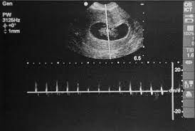 Ultrassom De 5 Semanas Nao Vi O Bebe E Agora Trocandofraldas Com Br