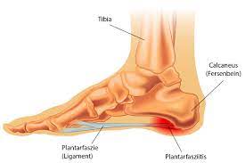Schmerzen beim gehen in den waden oder schmerzen im zehenbereich beim liegen sind typische zeichen einer fortgeschrittenen arteriosklerose (umgangssprachlich: Plantarfasziitis Ursachen Und Therapie Laufanalyse Info