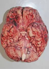 Image result for Brain Lesion