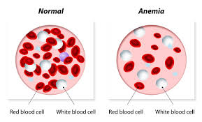 Diagnosis is typically by blood tests including a complete blood count, special hemoglobin tests, and genetic tests. Beta Thalassemia Medlineplus Genetics
