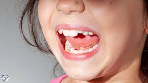 Snaggle Tooth: Causes, Challenges, And Treatment Options